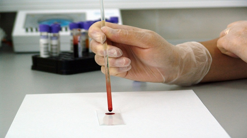 rapid test finds signs of sepsis in single drop of blood